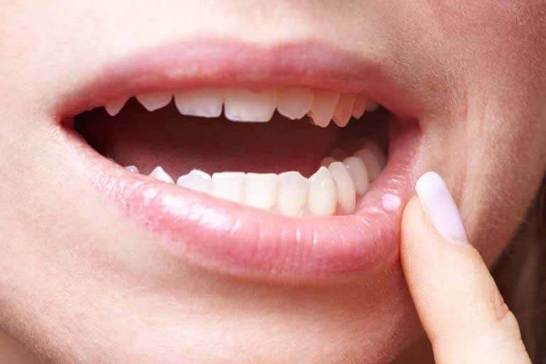 Ogizdagi qattiq chuqur cuma