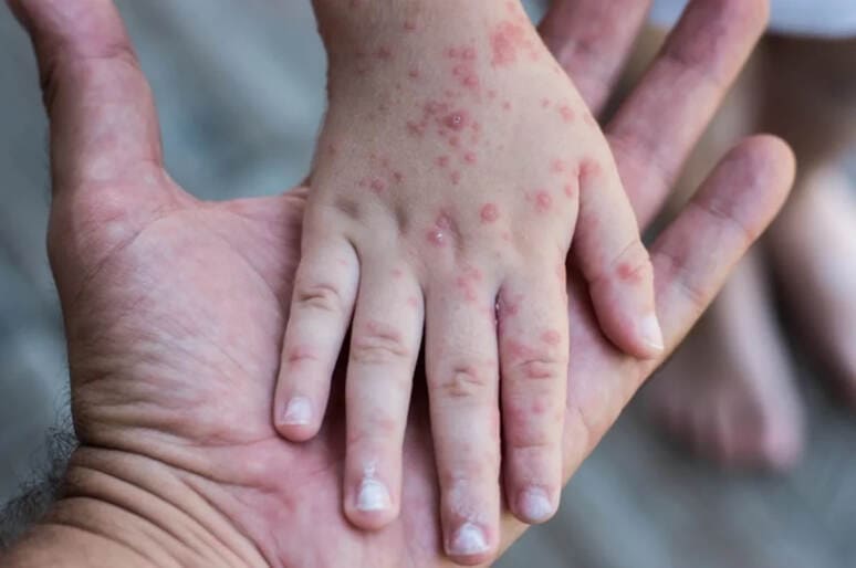 <p><b>Rossiyada bog‘cha va maktablarda yangi virus tarqalmoqda</b></p>