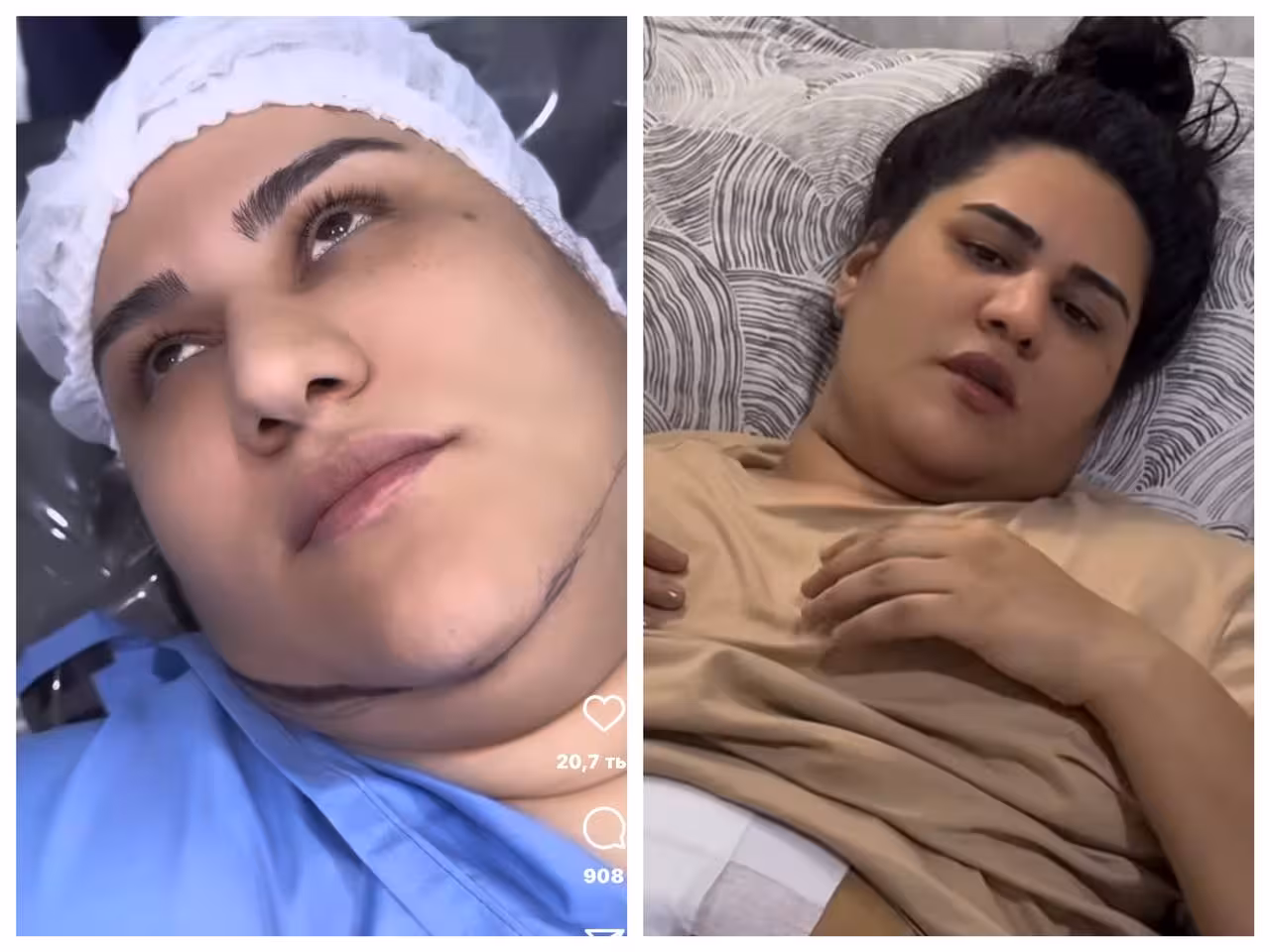 <p>Toshkentdagi xususiy klinikada reklama evaziga liposaksiya qildirgan bloger Komila Abduqodirovada operatsiyadan so&lsquo;ng nekroz yuzaga keldi<b>&nbsp;</b></p>