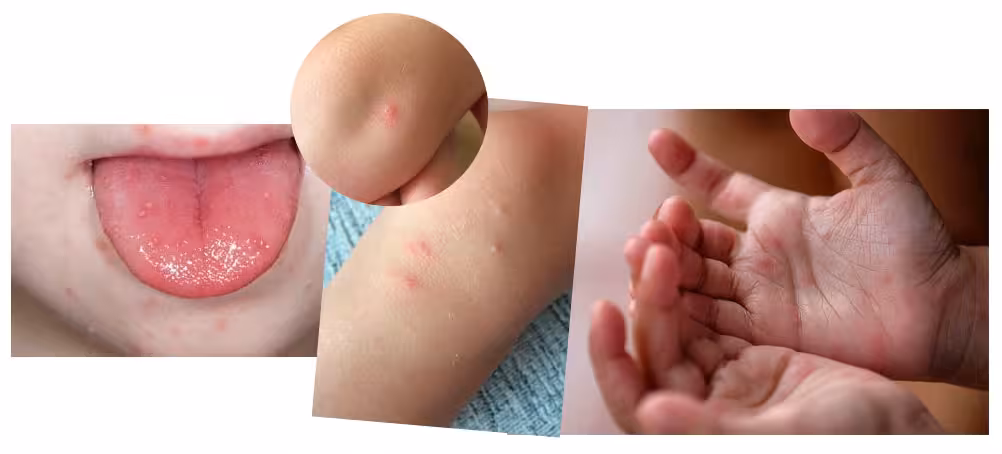 <p><b>Koksaki qanday virus va u nimasi bilan xavfli?</b></p>