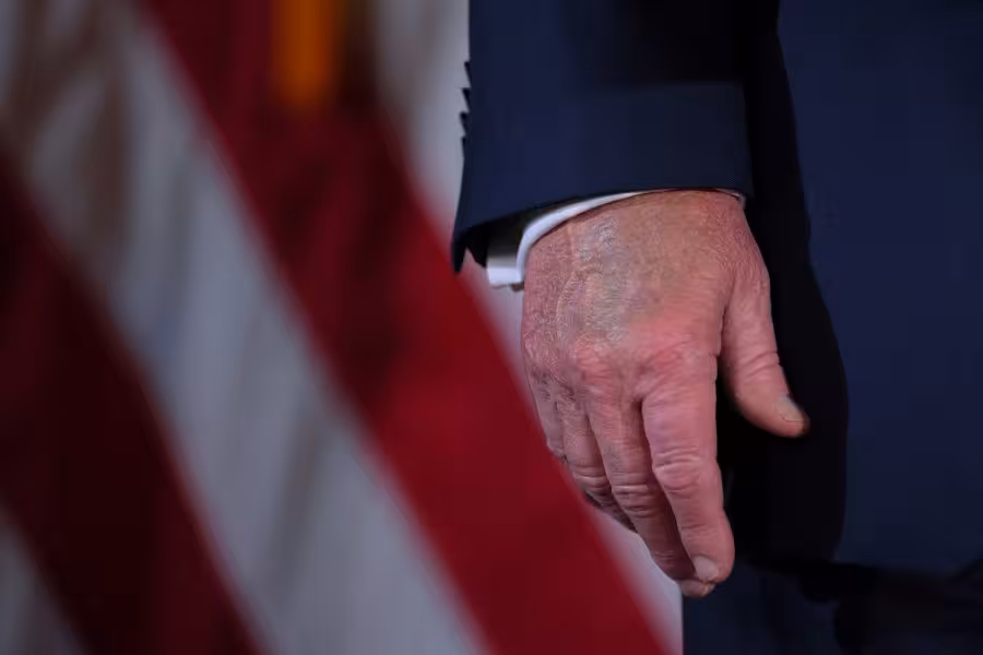 Donald Trampga surunkali venoz yetishmovchiligi tashxisi qo‘yildi. Bu xavfli kasallikmi?