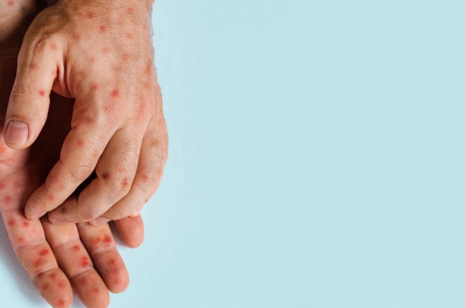 Qizamiqdan xoli hisoblangan Kanadada kasallik epidemiyasi qayd etildi