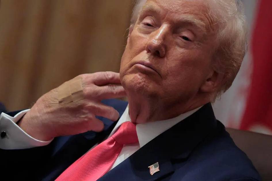 Oq uy Trampning qo‘lidagi jarohat sababini ma’lum qildi