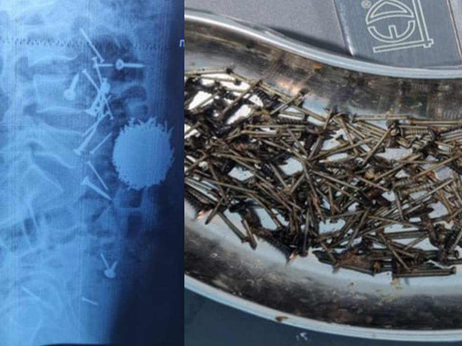 В Самарканде врачи извлекли из брюшной полости 29-летнего пациента около 200 граммов гвоздей