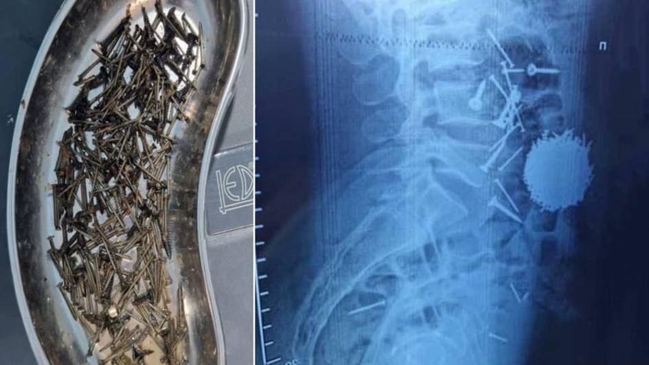 Самарқандда эркак стресс сабаб 200 грамм мих ютиб юборди