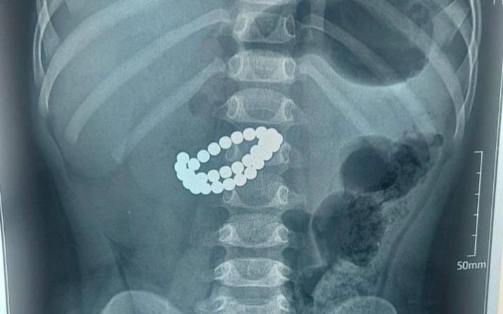 Qozog‘istonda bolaning ichagidan 31 ta magnit chiqarib olindi