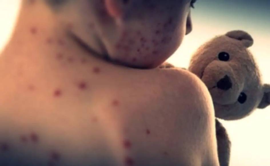 Bangladeshda qizamiq epidemiyasidan 194 nafar bola vafot etdi