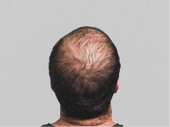 Anusdan oqib chiqadigan sperma toplami